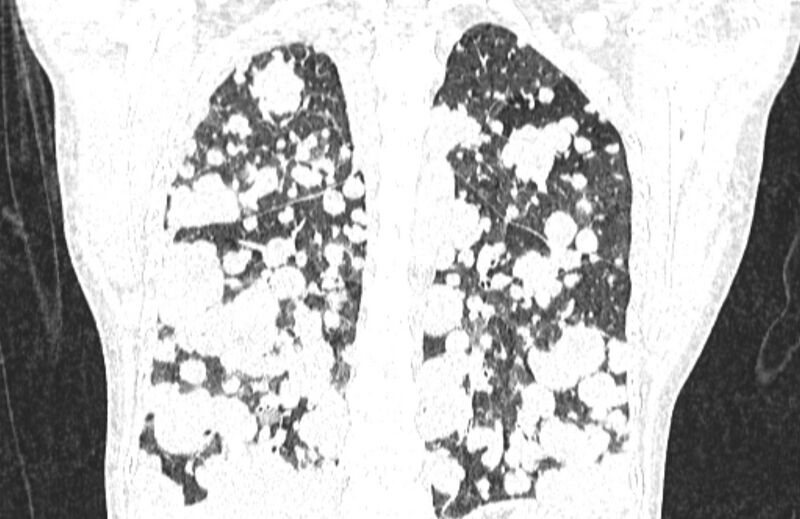 File:Cannonball metastases from breast cancer (Radiopaedia 91024-108569 Coronal lung window 104).jpg