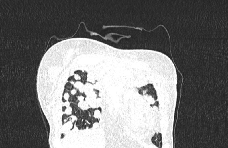 File:Cannonball metastases from breast cancer (Radiopaedia 91024-108569 Coronal lung window 16).jpg