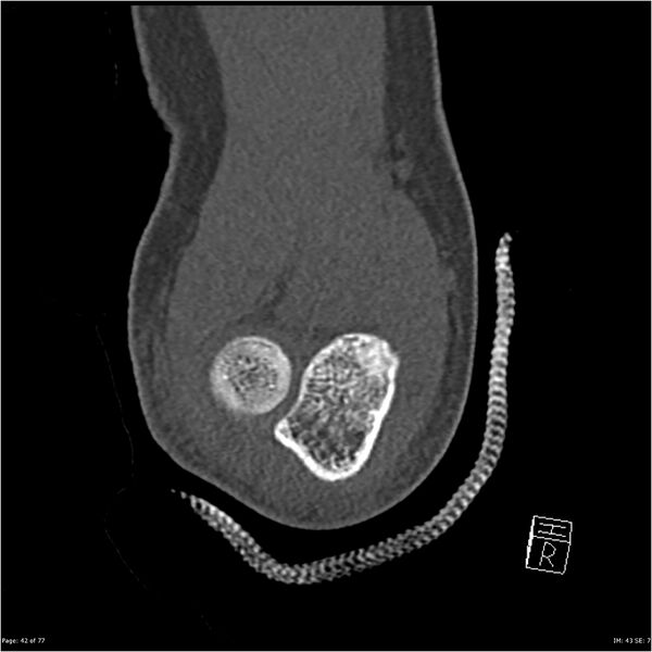File:Capitellum fracture (Radiopaedia 23352-23426 Coronal bone window 42).jpg