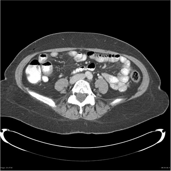 File:Carcinoid tumor of the ileum with metastasis to orbit (Radiopaedia 28165-28425 A 13).jpg