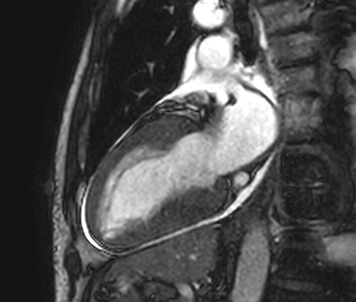 File:Cardiac amyloidosis (Radiopaedia 39736-42124 B 29).jpg