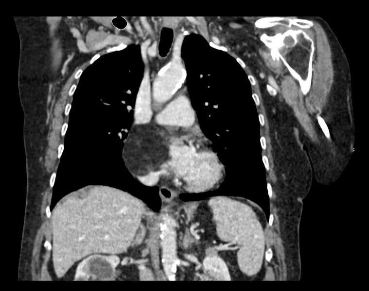 File:Cardiac lipoma (Radiopaedia 15292-15111 B 1).JPG