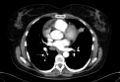 Cardiac sarcoidosis (Radiopaedia 74548-85534 A 45).jpg