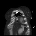 Cardiogenic pulmonary edema (Radiopaedia 29213-29609 Coronal non-contrast 3).jpg
