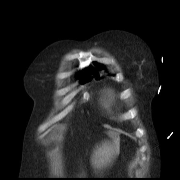 File:Cardiogenic pulmonary edema (Radiopaedia 29213-29609 Coronal non-contrast 3).jpg