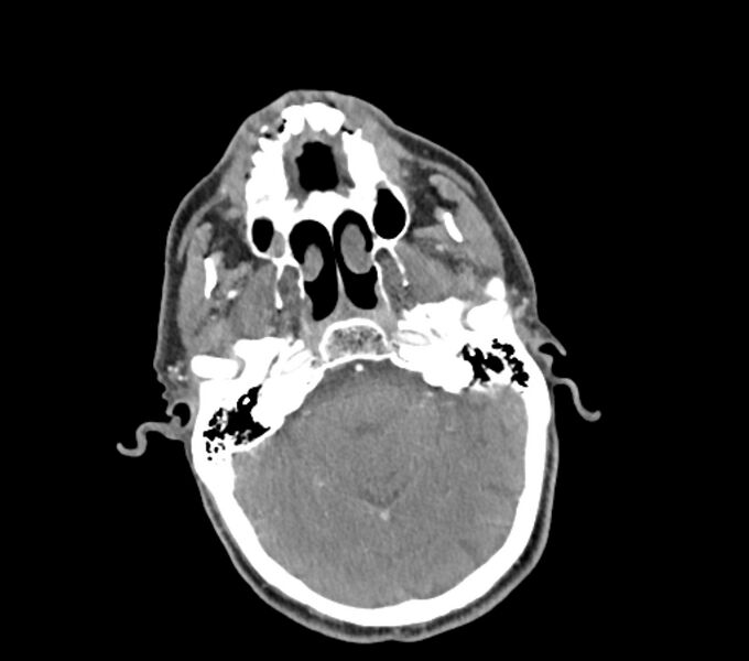 File:Carotid artery pseudoaneurysm (Radiopaedia 84030-99259 C 8).jpg