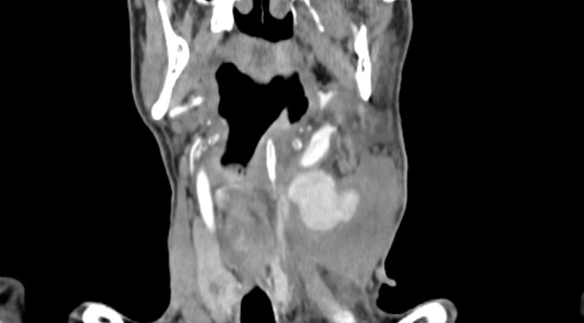 Carotid artery pseudoaneurysm (Radiopaedia 84030-99259 D 41).jpg