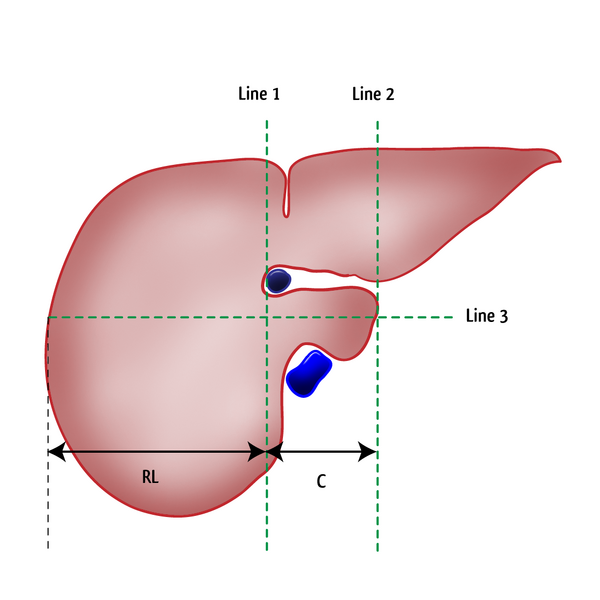 File:Caudate-right lobe ratio (diagram) (Radiopaedia 8072).png