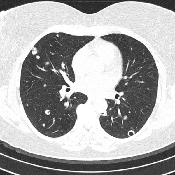File:Cavitating pulmonary metastases (Radiopaedia 17796-17555 Axial lung window 10).jpg