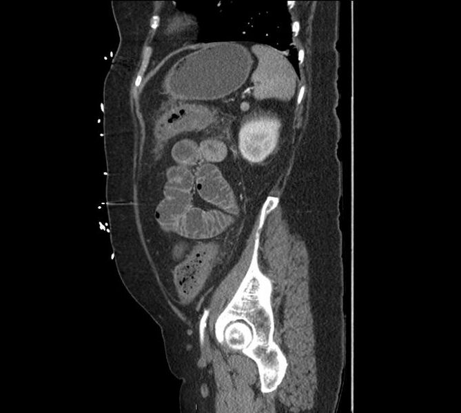 File:Celiac artery severe stenosis and dissection (Radiopaedia 44128-47842 A 9).jpg