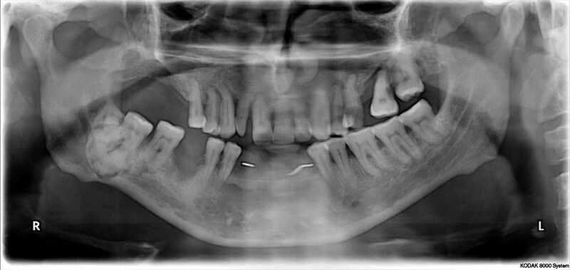 File:Cemento-ossifying fibroma (Radiopaedia 10166-10700 Frontal 1).jpg