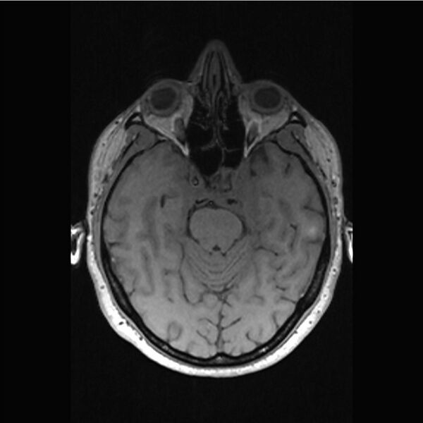 File:Central base of skull meningioma (Radiopaedia 53531-59549 Axial T1 15).jpg
