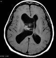Central neurocytoma (Radiopaedia 4355-6613 Axial T1 1).jpg