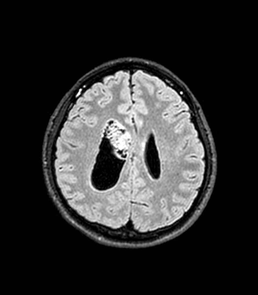 Central neurocytoma (Radiopaedia 79320-92380 Axial FLAIR 109).jpg