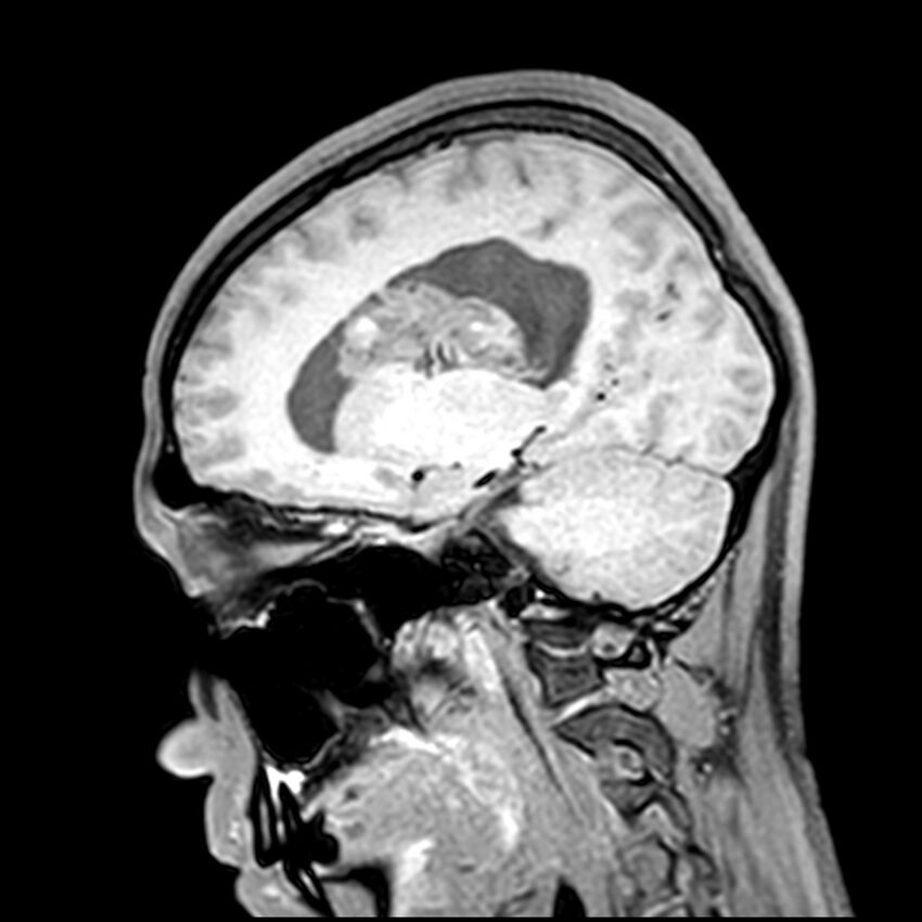 Central neurocytoma (Radiopaedia 79320-92380 Sagittal T1 159).jpg