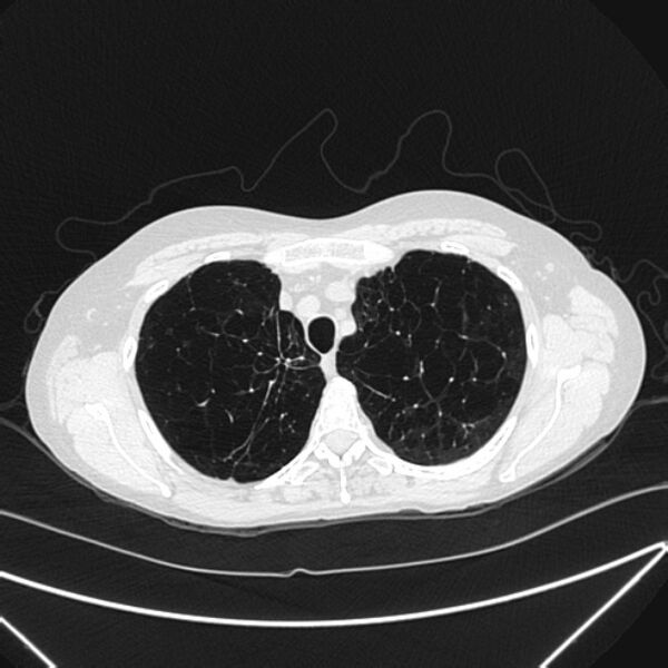File:Centrilobular pulmonary emphysema (Radiopaedia 24495-24789 Axial lung window 19).jpg