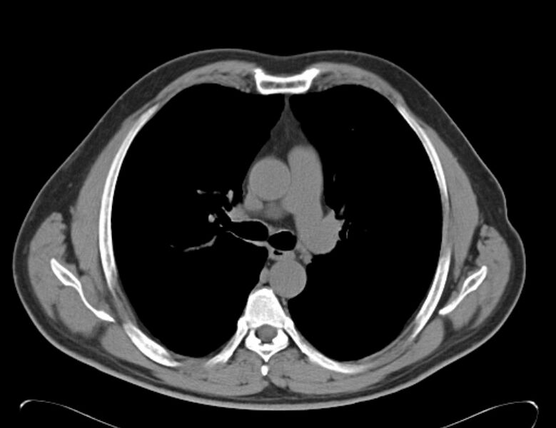 File:Centrilobular pulmonary emphysema (Radiopaedia 26808-26971 Axial non-contrast 19).jpg