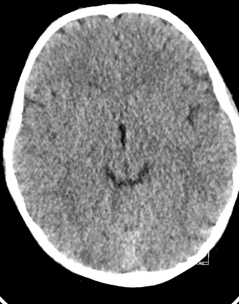 File:Cerebellar stroke (Radiopaedia 32202-33149 Axial non-contrast 11).png