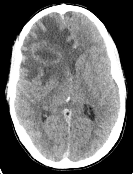 File:Cerebral abscess (Radiopaedia 60342-68008 Axial non-contrast 27).png