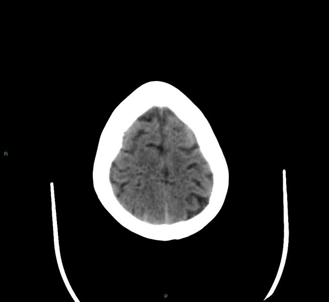 File:Cerebral amyloid angiopathy-associated lobar intracerebral hemorrhage (Radiopaedia 58377-65514 Axial non-contrast 9).jpg