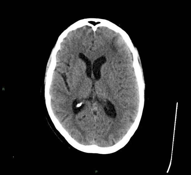File:Cerebral amyloid angiopathy-associated lobar intracerebral hemorrhage (Radiopaedia 58529-65681 Axial non-contrast 26).jpg
