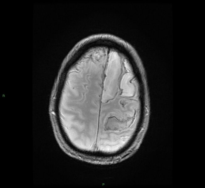 File:Cerebral amyloid angiopathy-associated lobar intracerebral hemorrhage (Radiopaedia 58529-65684 Axial Gradient Echo 21).jpg