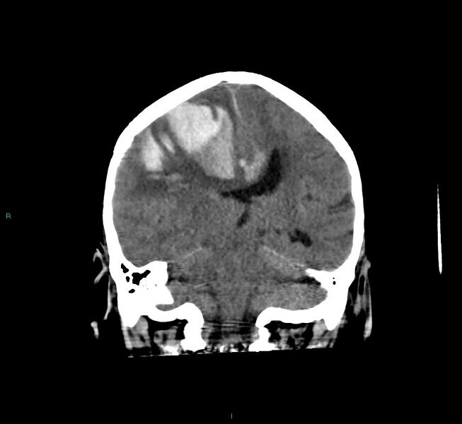 File:Cerebral amyloid angiopathy-associated lobar intracerebral hemorrhage (Radiopaedia 58560-65723 Coronal non-contrast 32).jpg