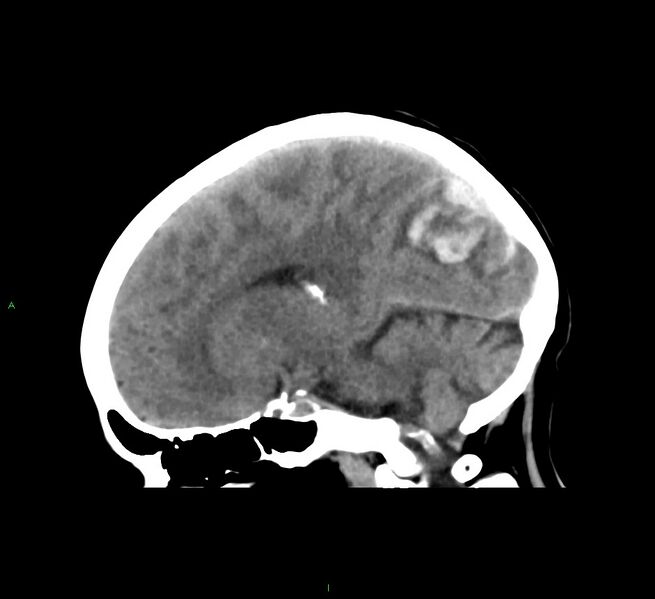 File:Cerebral amyloid angiopathy-associated lobar intracerebral hemorrhage (Radiopaedia 58563-65727 C 25).jpg
