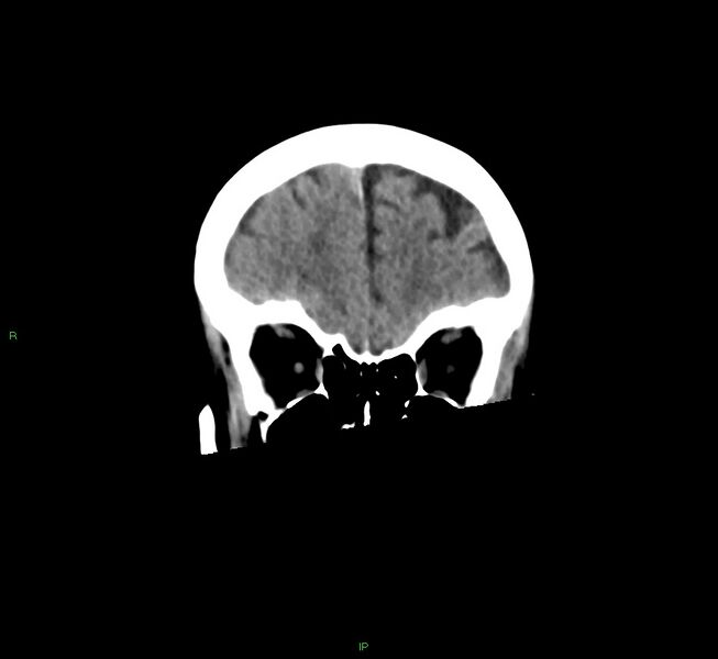 File:Cerebral amyloid angiopathy-associated lobar intracerebral hemorrhage (Radiopaedia 58563-65727 Coronal non-contrast 52).jpg