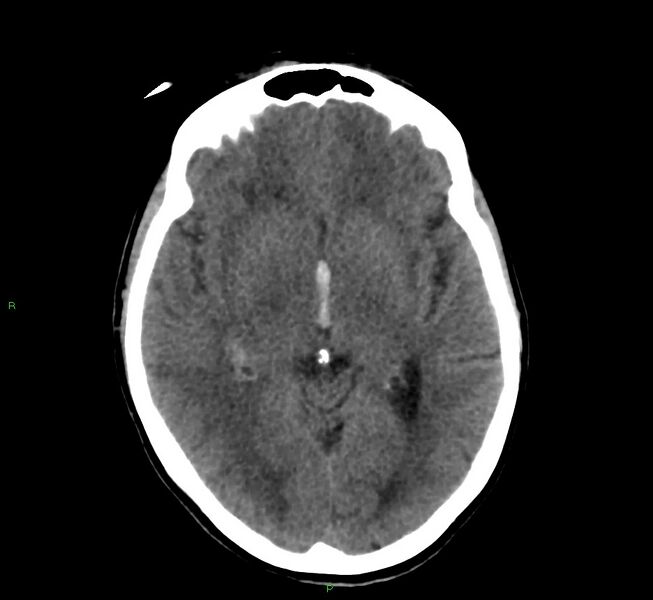 File:Cerebral amyloid angiopathy-associated lobar intracerebral hemorrhage (Radiopaedia 58566-65730 Axial non-contrast 29).jpg