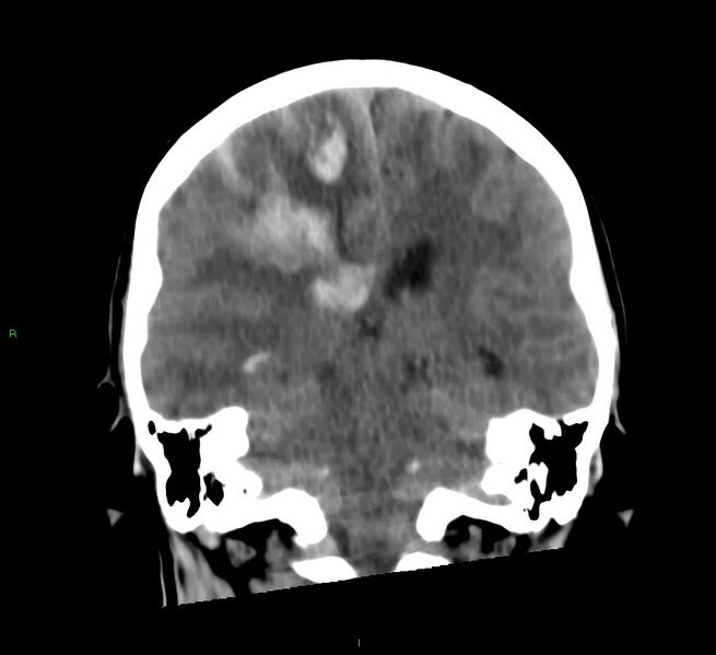 File:Cerebral amyloid angiopathy-associated lobar intracerebral hemorrhage (Radiopaedia 58566-65730 Coronal non-contrast 32).jpg