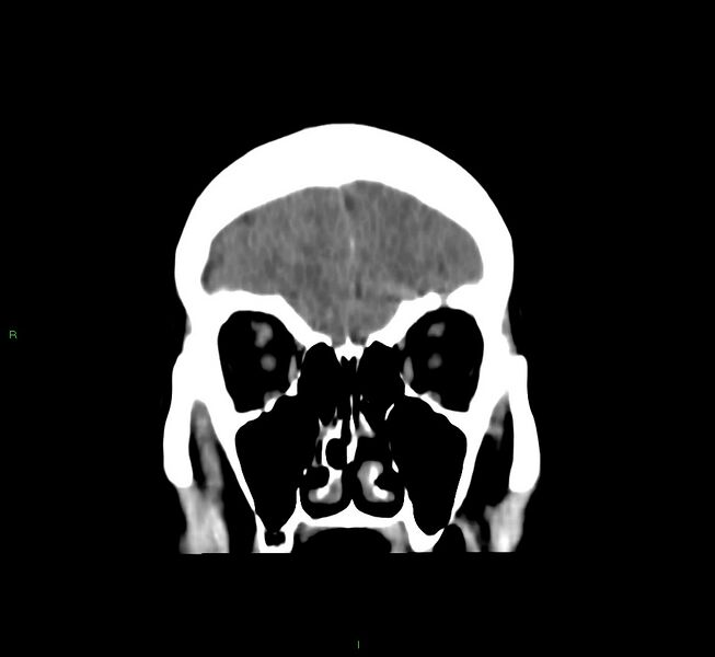 File:Cerebral amyloid angiopathy-associated lobar intracerebral hemorrhage (Radiopaedia 58751-65972 Coronal non-contrast 50).jpg