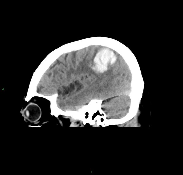 File:Cerebral amyloid angiopathy-associated lobar intracerebral hemorrhage (Radiopaedia 59356-66716 C 15).jpg