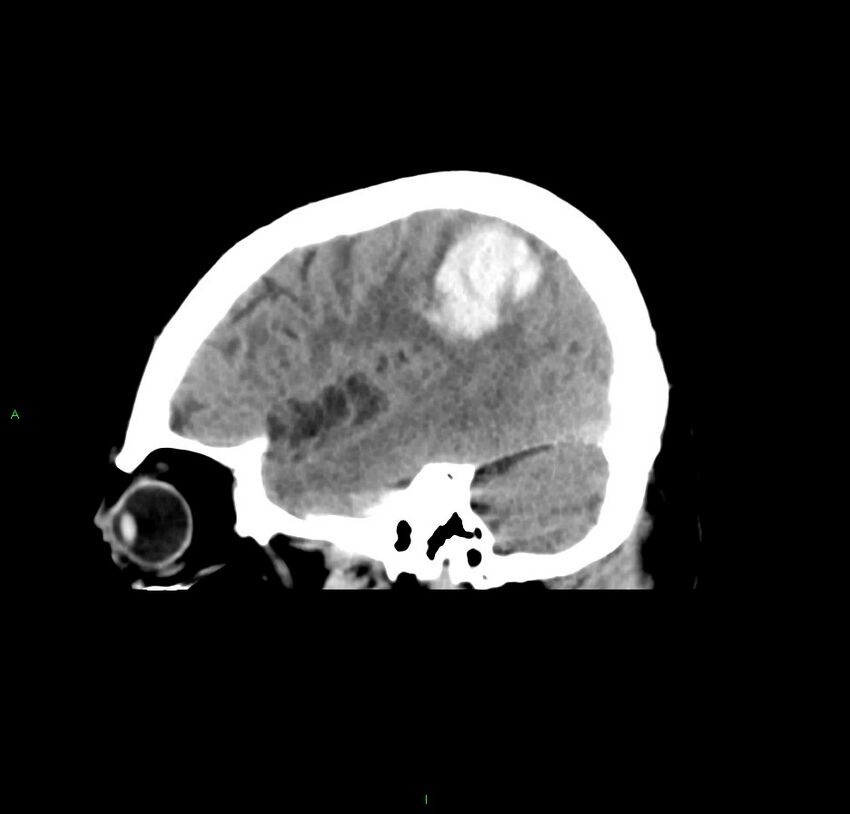 Cerebral amyloid angiopathy-associated lobar intracerebral hemorrhage (Radiopaedia 59356-66716 C 15).jpg