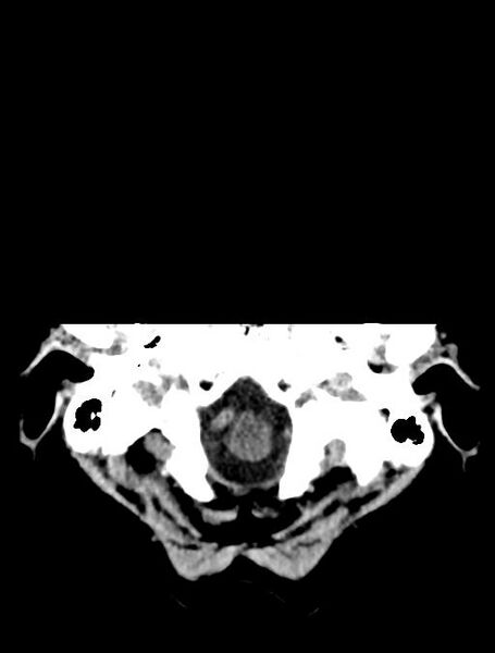 File:Cerebral aneurysm with rupture (Radiopaedia 29933-30457 Axial non-contrast 2).jpg
