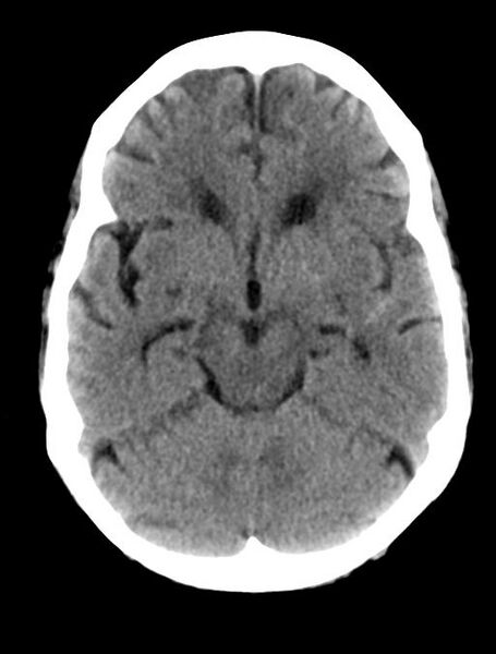 File:Cerebral aneurysm with rupture (Radiopaedia 29933-30457 Axial non-contrast 9).jpg