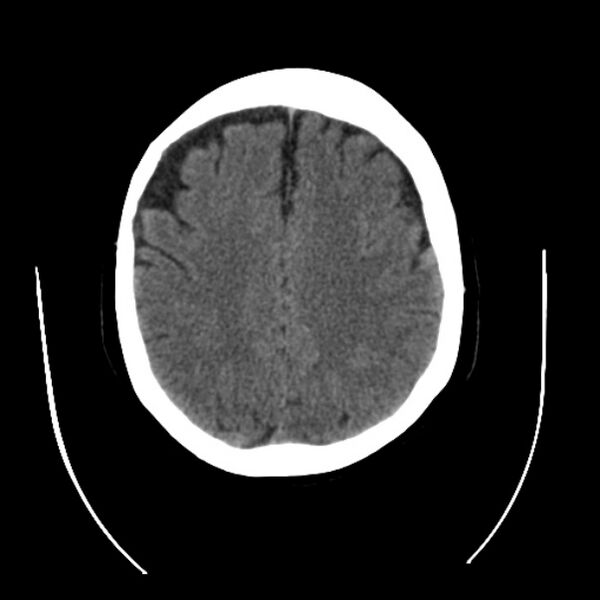 File:Cerebral arteriovenous malformation (Radiopaedia 43729-47189 Axial non-contrast 29).jpg