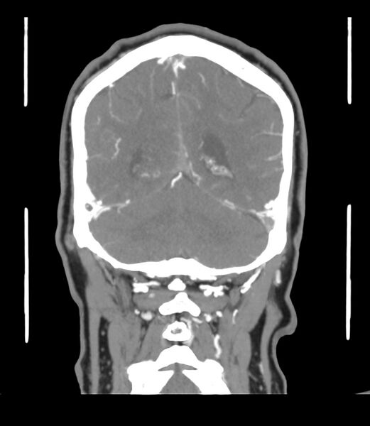 File:Cerebral dural venous sinus thrombosis (Radiopaedia 86514-102576 B 55).jpg
