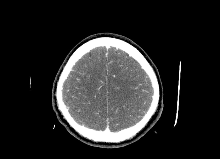 Cerebral edema (Radiopaedia 82519-96661 B 16).jpg