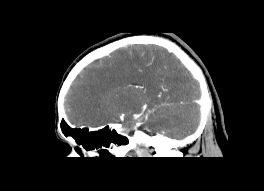 Cerebral edema (Radiopaedia 82519-96661 D 23).jpg
