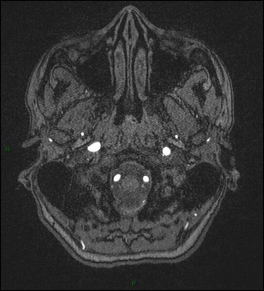 File:Cerebral fat embolism (Radiopaedia 35022-36525 Axial TOF 8).jpg