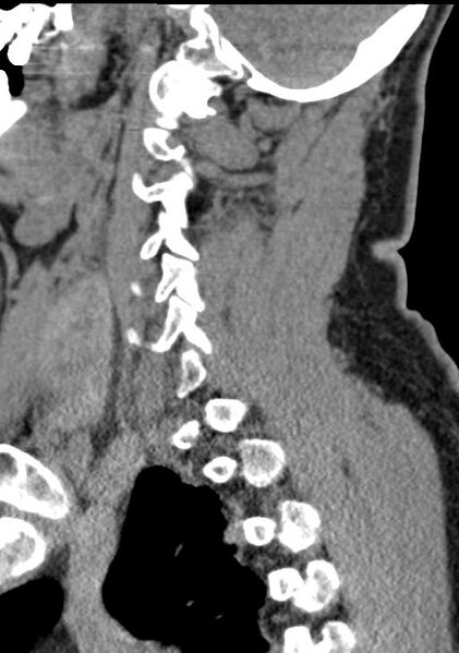 File:Cerebral hemorrhagic contusions and cervical spine fractures (Radiopaedia 32865-33841 G 76).jpg