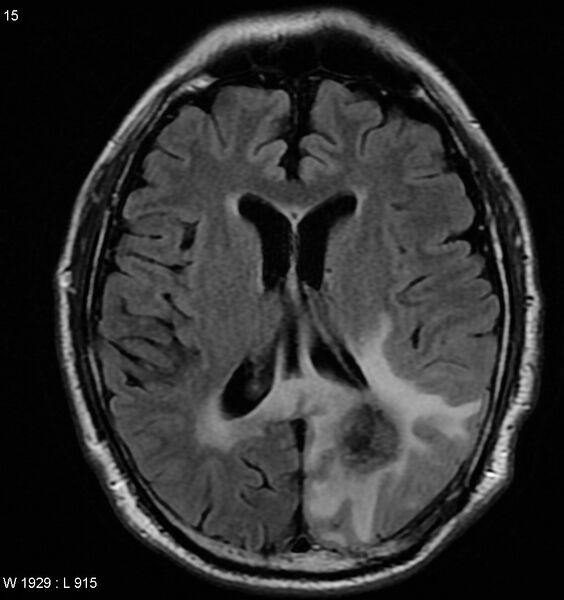 File:Cerebral radiation necrosis (Radiopaedia 5665-7376 Axial FLAIR 1).jpg