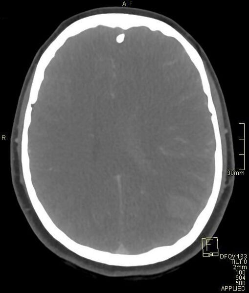 File:Cerebral venous sinus thrombosis (Radiopaedia 91329-108965 Axial venogram 51).jpg