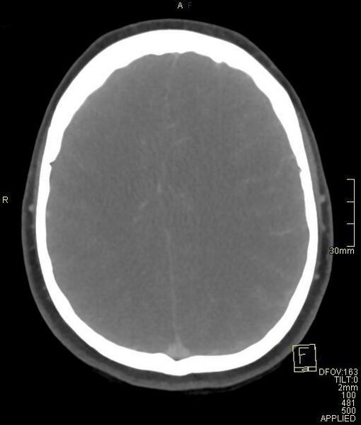 File:Cerebral venous sinus thrombosis (Radiopaedia 91329-108965 Axial venogram 57).jpg