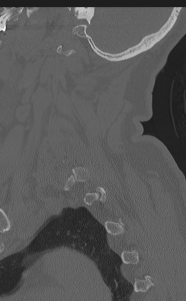 File:Cervical canal stenosis due to ossification of the posterior longitudinal ligament (Radiopaedia 47260-51823 Sagittal bone window 14).png