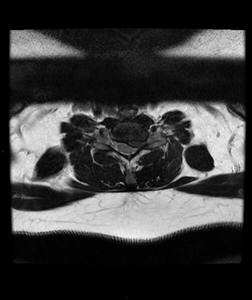 File:Cervical disc prolapse (Radiopaedia 80258-93598 Axial T2 57).jpg