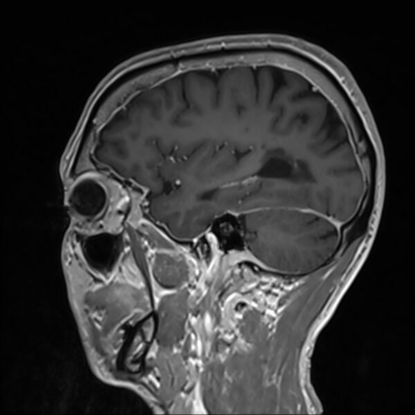 File:Cervical dural CSF leak on MRI and CT treated by blood patch (Radiopaedia 49748-54995 G 87).jpg