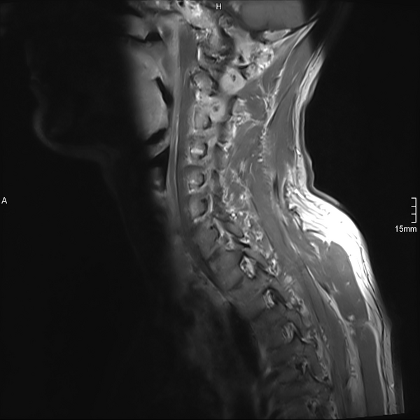 File:Cervical dural CSF leak on MRI and CT treated by blood patch (Radiopaedia 49748-54995 Sagittal T1 C+ 1).png