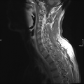 Cervical dural CSF leak on MRI and CT treated by blood patch (Radiopaedia 49748-54995 Sagittal T1 C+ 8).png